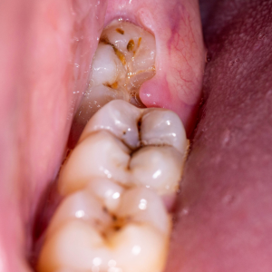 konyagomuludiscekimi