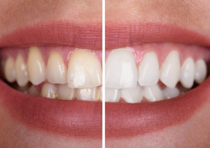 Evde ve klinikte diş beyazlatma yöntemlerinin karşılaştırmalı görünümü.