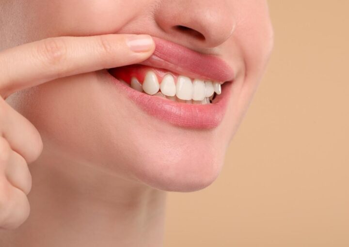 Diş eti hastalıklarında sağlıklı ve iltihaplı diş eti görünümünün karşılaştırılması.