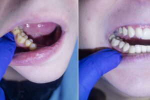 Diş taşı oluşumu ve diş taşı temizliği sonrası diş eti görünümünü gösteren bilgilendirici görsel.