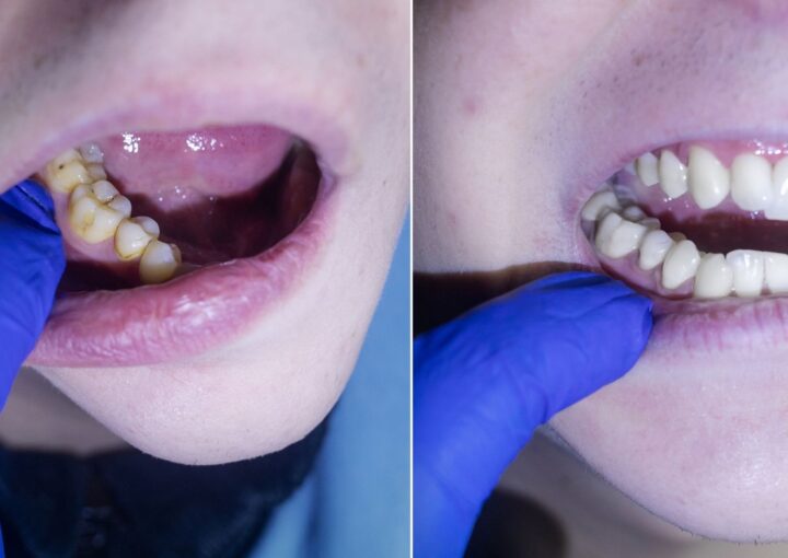 Diş taşı oluşumu ve diş taşı temizliği sonrası diş eti görünümünü gösteren bilgilendirici görsel.