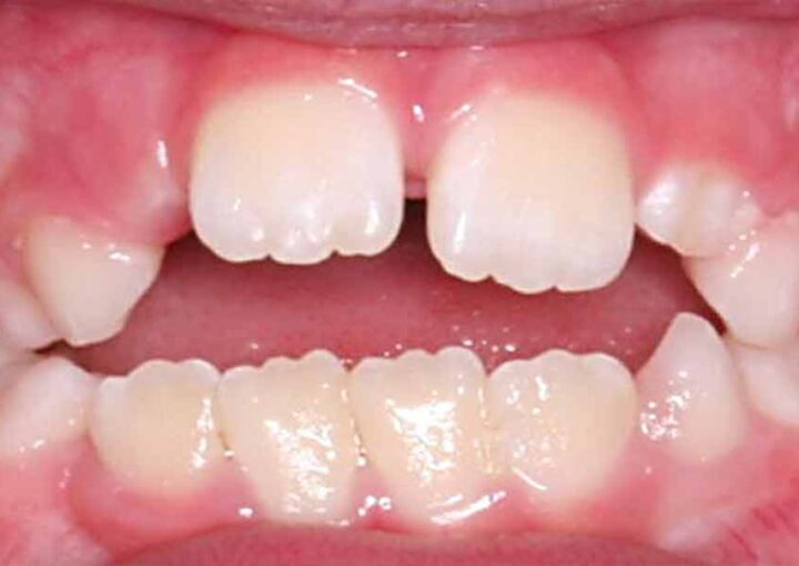 Parmak emme alışkanlığının çocuklarda diş dizilimi ve ağız yapısı üzerindeki etkilerini gösteren görsel.