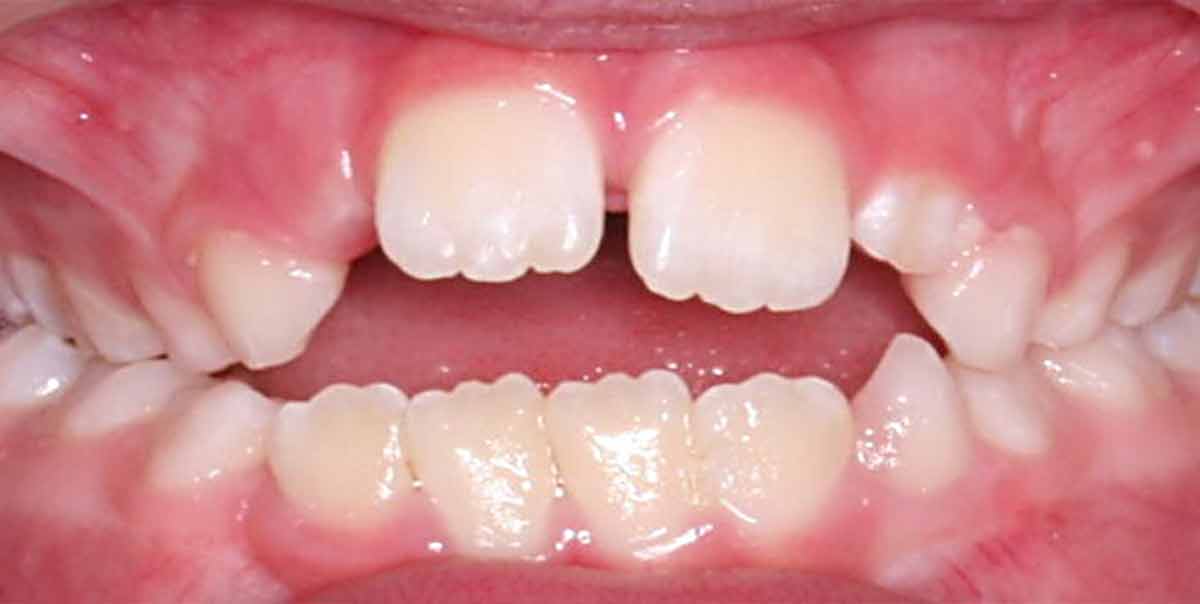 Parmak emme alışkanlığının çocuklarda diş dizilimi ve ağız yapısı üzerindeki etkilerini gösteren görsel.