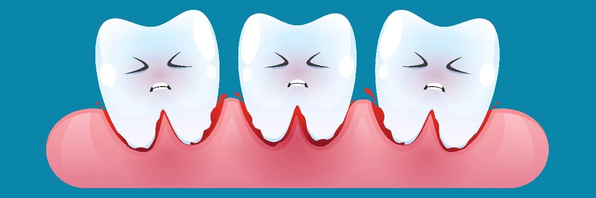 Diş eti kanaması, hassasiyet ve çekilmenin ağız içindeki görünümünü gösteren bilgilendirici görsel.