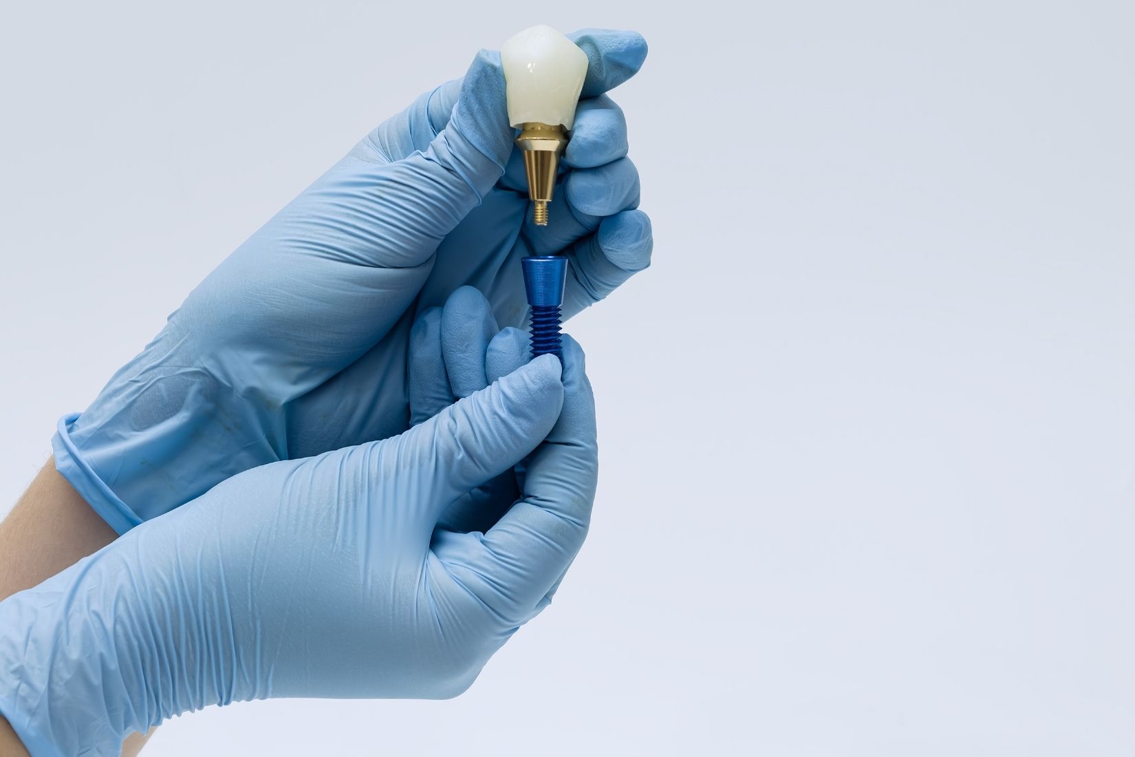 Çene kemiğine yerleştirilen dental implant ve implant üstü protez aşamalarını gösteren bilgilendirici görsel.