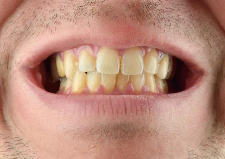 Dişlerde sararma ve doğal diş rengi farkını gösteren bilgilendirici ağız içi görsel.