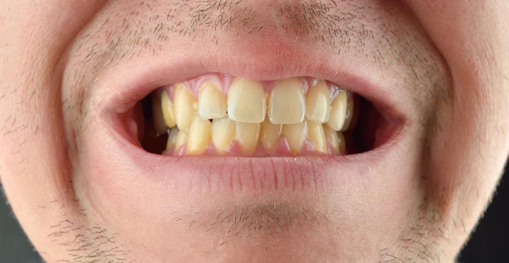 Dişlerde sararma ve doğal diş rengi farkını gösteren bilgilendirici ağız içi görsel.
