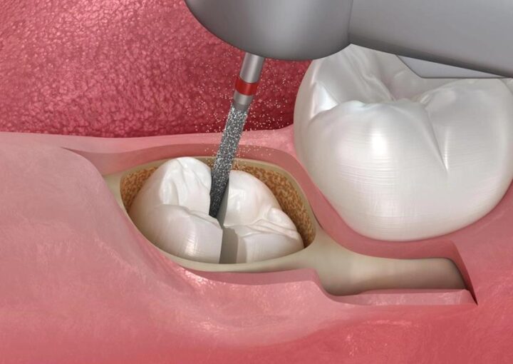 Gömülü dişin röntgen görüntüsü ve cerrahi çıkarma sürecini gösteren diş hekimliği görseli.