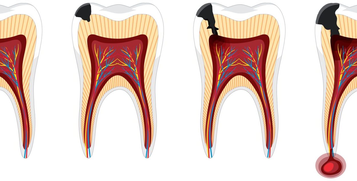 Kanal tedavisi tekrarı ve fiber post uygulamasını gösteren detaylı diş hekimliği görseli.
