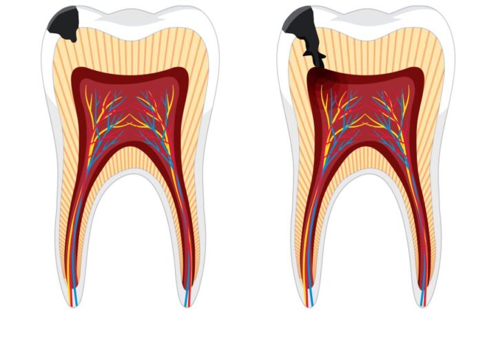 Kanal tedavisi tekrarı ve fiber post uygulamasını gösteren detaylı diş hekimliği görseli.
