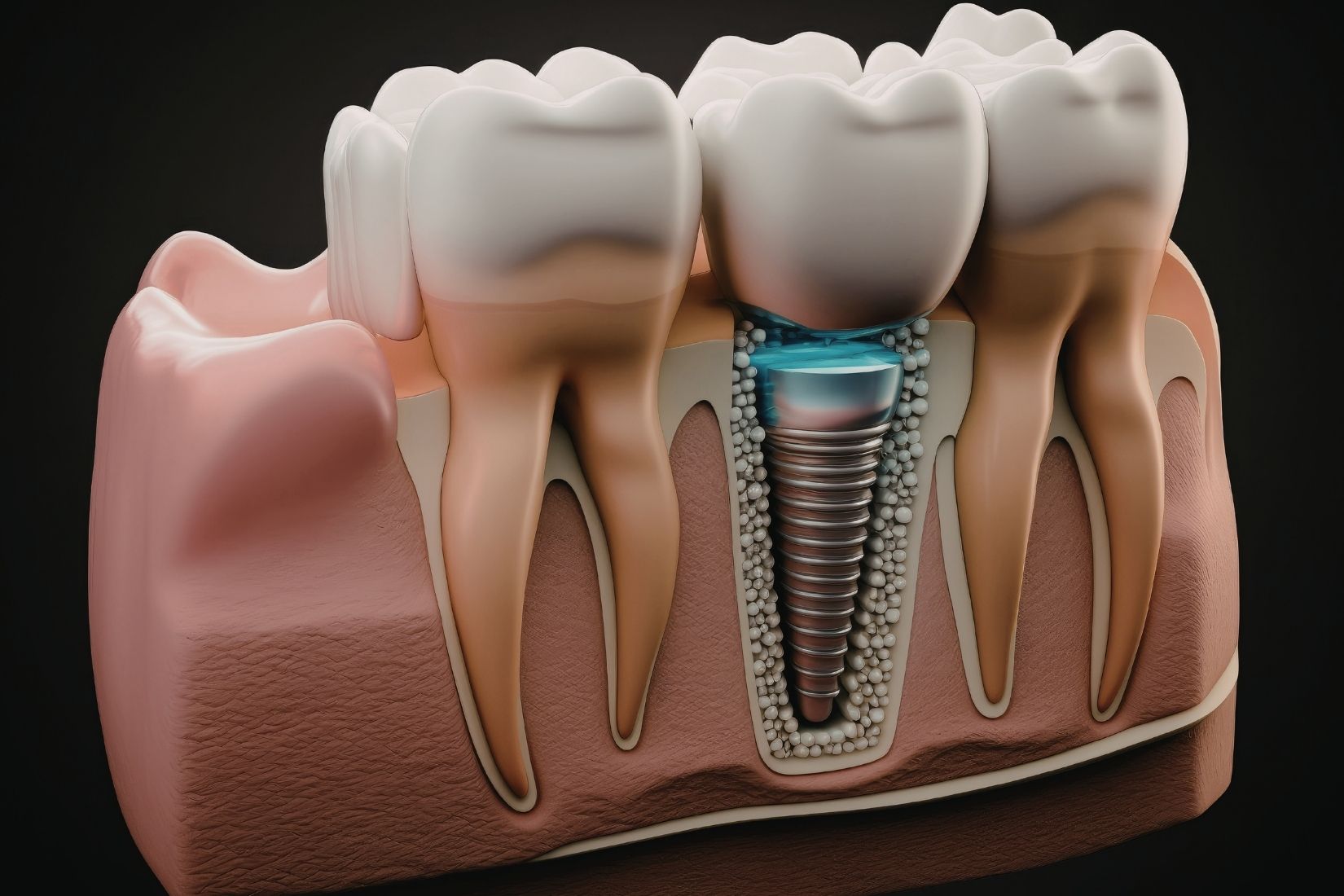 Kemik yetersizliği olan bölgede implant planlaması ve kemik artırma işlemlerini gösteren dental görsel.