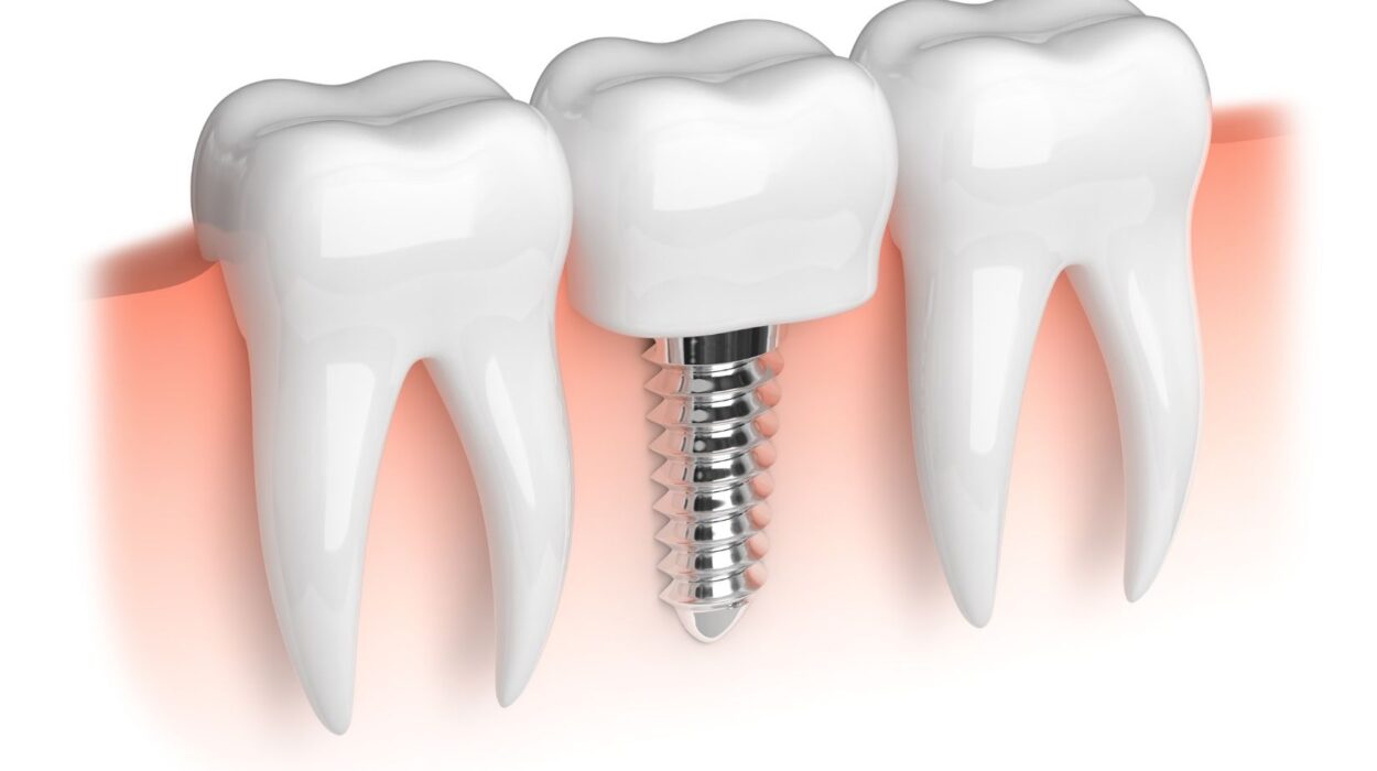 Dental implant tedavisi sürecini ve implant üstü diş restorasyonunu gösteren bilgilendirici diş hekimliği görseli.