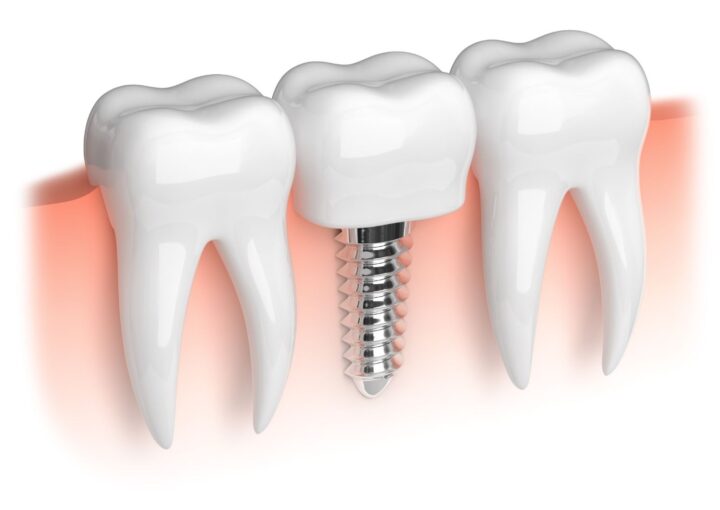 Dental implant tedavisi sürecini ve implant üstü diş restorasyonunu gösteren bilgilendirici diş hekimliği görseli.