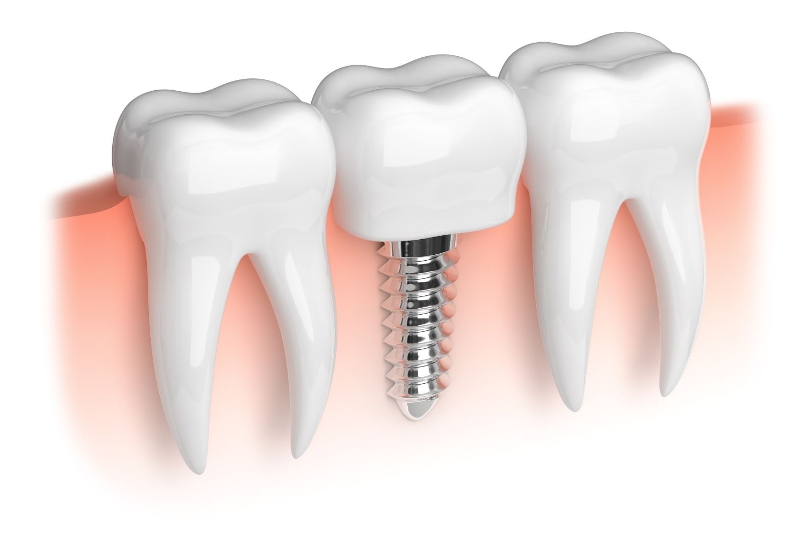 Dental implant tedavisi sürecini ve implant üstü diş restorasyonunu gösteren bilgilendirici diş hekimliği görseli.