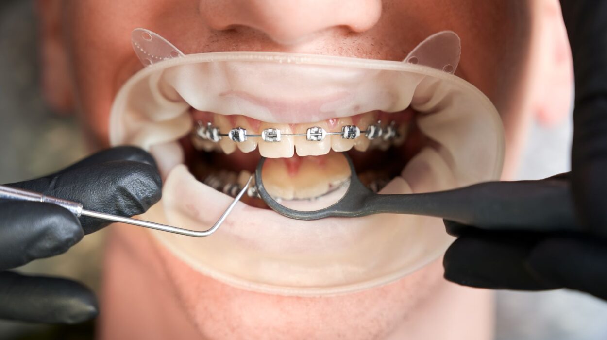 Ortodonti tedavisi sürecinde dişlerin hizalanmasını ve diş teli uygulamasını gösteren bilgilendirici görsel.