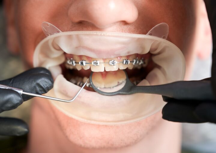 Ortodonti tedavisi sürecinde dişlerin hizalanmasını ve diş teli uygulamasını gösteren bilgilendirici görsel.