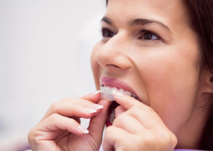 Dişlerde şeffaf plak uygulamasını ve ortodontik hizalanma sürecini gösteren bilgilendirici görsel.