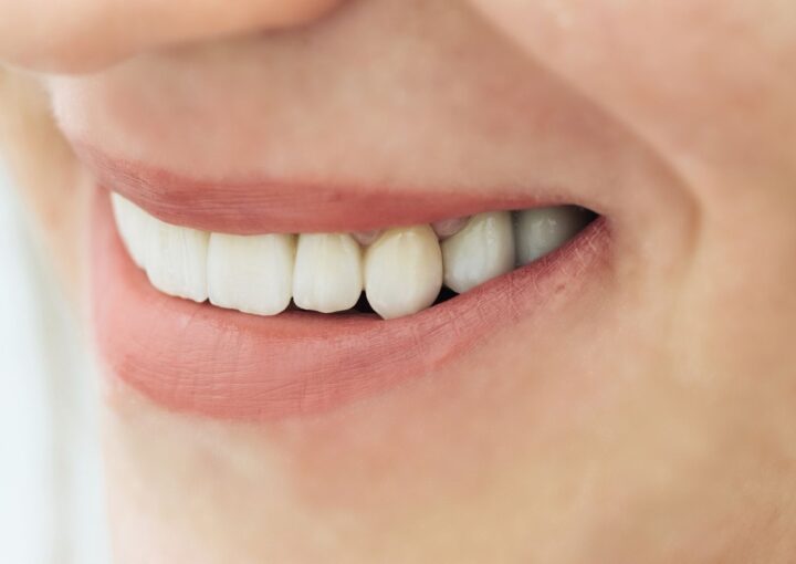 zirkonyum-kaplama-mi-porselen-kaplama-mi