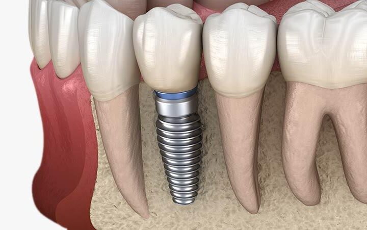 Dental implant tedavisinin aşamalarını ve kemik ile kaynaşma sürecini gösteren bilgilendirici görsel.