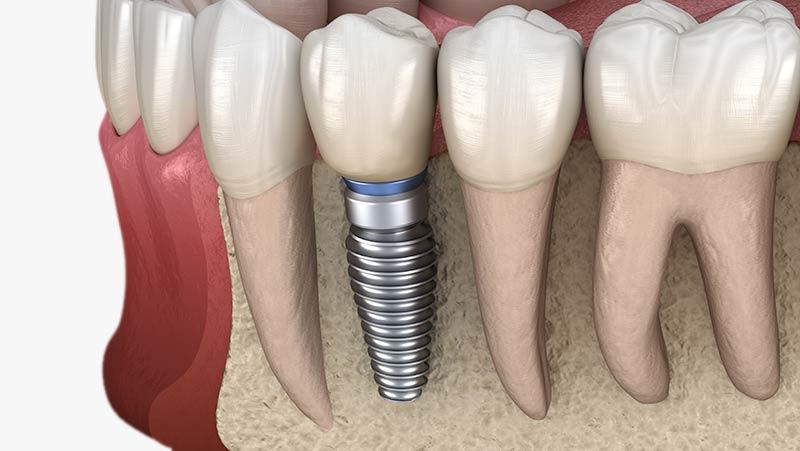 Dental implant tedavisinin aşamalarını ve kemik ile kaynaşma sürecini gösteren bilgilendirici görsel.