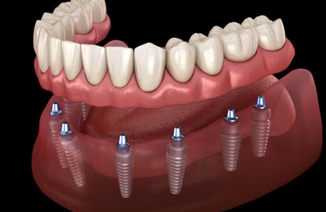 All-on-4 ve All-on-6 implant sistemi ile tam çene sabit protez uygulamasını gösteren görsel.