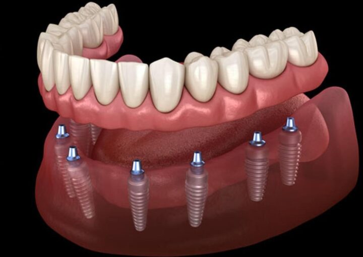 All-on-4 ve All-on-6 implant sistemi ile tam çene sabit protez uygulamasını gösteren görsel.