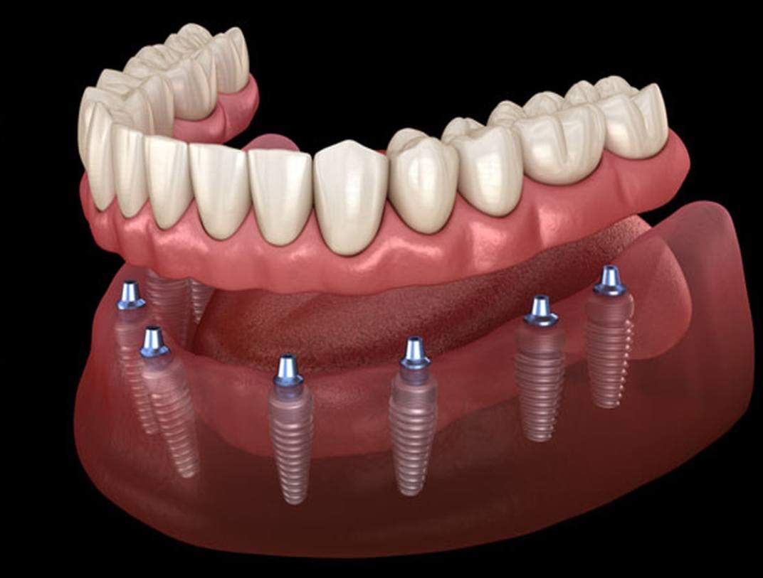 All-on-4 ve All-on-6 implant sistemi ile tam çene sabit protez uygulamasını gösteren görsel.