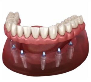 Tam ağız implant tedavisi ve implant üstü sabit protez uygulamasını gösteren diş hekimliği görseli.