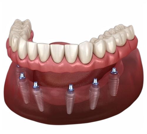 Tam ağız implant tedavisi ve implant üstü sabit protez uygulamasını gösteren diş hekimliği görseli.
