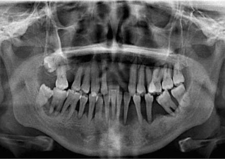 Diyabet hastasında implant tedavisi planlaması ve diş hekimi değerlendirmesini gösteren görsel.