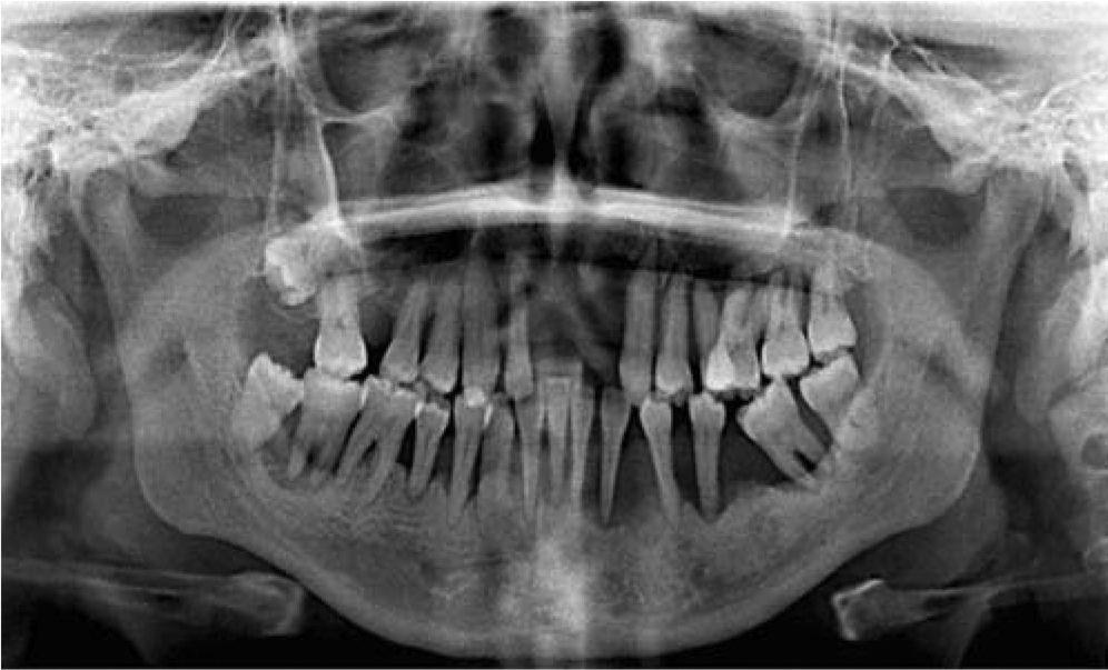 Diyabet hastasında implant tedavisi planlaması ve diş hekimi değerlendirmesini gösteren görsel.