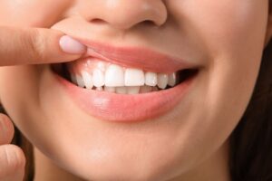 Diş eti büyümesi bulunan bölgenin periodontal muayene sırasında değerlendirildiğini gösteren ağız ve diş sağlığı görseli.