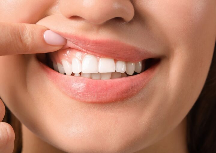 Diş eti büyümesi bulunan bölgenin periodontal muayene sırasında değerlendirildiğini gösteren ağız ve diş sağlığı görseli.