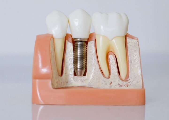 Diş implantı çevresindeki diş eti ve destek dokuların rutin kontrol sırasında değerlendirildiği diş hekimliği muayenesi.