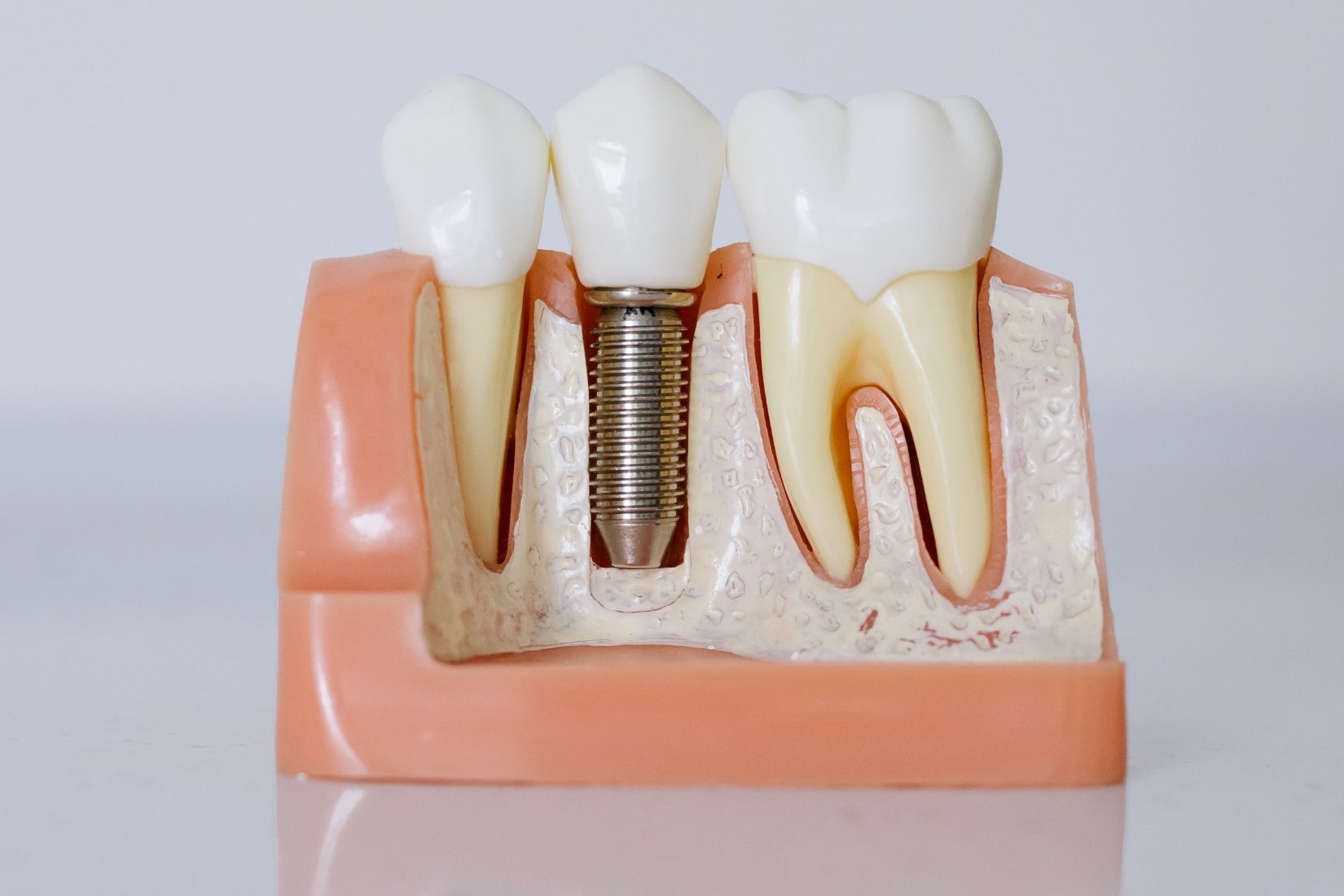 Diş implantı çevresindeki diş eti ve destek dokuların rutin kontrol sırasında değerlendirildiği diş hekimliği muayenesi.