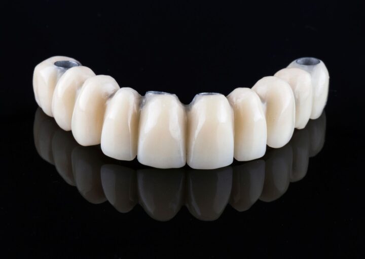 İmplant üstü protez planlamasında ağız yapısı, implant konumları ve kapanış ilişkisinin değerlendirildiği diş hekimliği muayenesi.