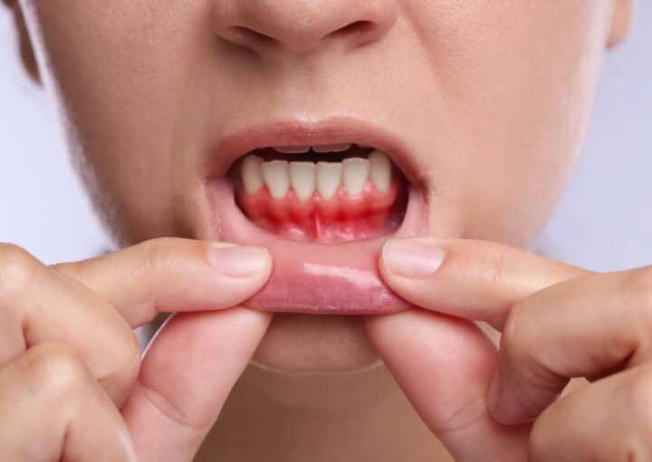 Diş eti çekilmesi bulunan bir hastada kök yüzeyi, diş eti seviyesi ve periodontal dokuların değerlendirildiği muayene.