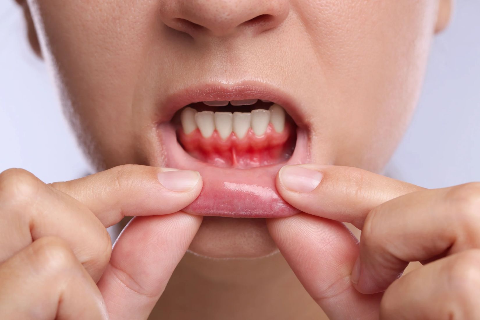 Diş eti çekilmesi bulunan bir hastada kök yüzeyi, diş eti seviyesi ve periodontal dokuların değerlendirildiği muayene.