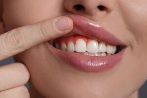 Diyabeti bulunan hastada diş eti sağlığı ve periodontal dokuların klinik muayene sırasında değerlendirildiği görsel.
