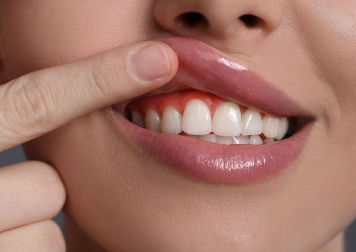 Diyabeti bulunan hastada diş eti sağlığı ve periodontal dokuların klinik muayene sırasında değerlendirildiği görsel.