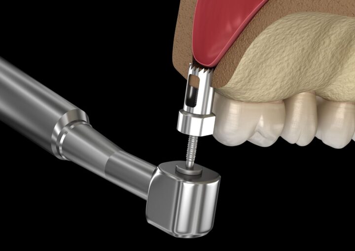 Üst çene arka bölgede implant öncesi kemik ve maksiller sinüs yapısının radyografik olarak değerlendirilmesi.