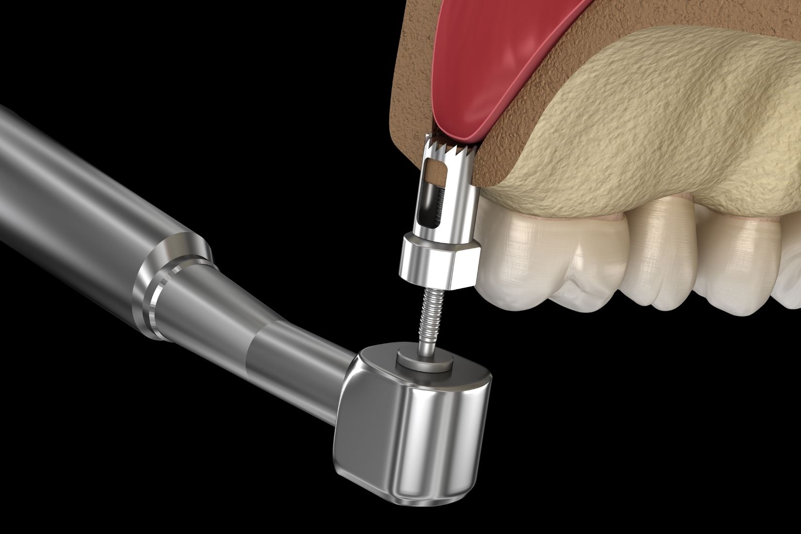 Üst çene arka bölgede implant öncesi kemik ve maksiller sinüs yapısının radyografik olarak değerlendirilmesi.