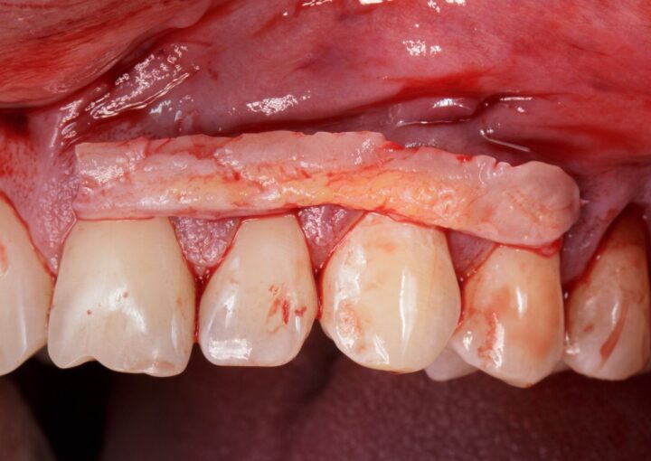 Diş eti çekilmesi bulunan bölgede kök yüzeyi ve yumuşak doku kalınlığının periodontal muayenede değerlendirildiği görsel.