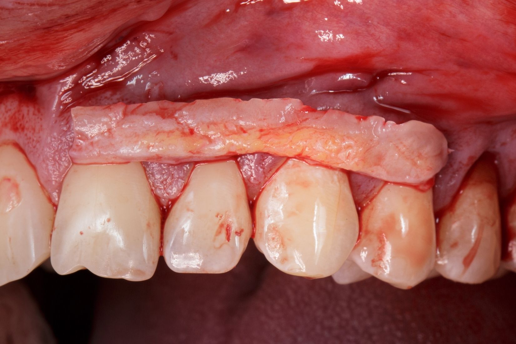 Diş eti çekilmesi bulunan bölgede kök yüzeyi ve yumuşak doku kalınlığının periodontal muayenede değerlendirildiği görsel.