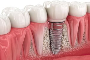 Eksik diş bölgesinde çene kemiği, dental implant ve implant üstü protezin anatomik yerleşimini gösteren diş hekimliği görseli.