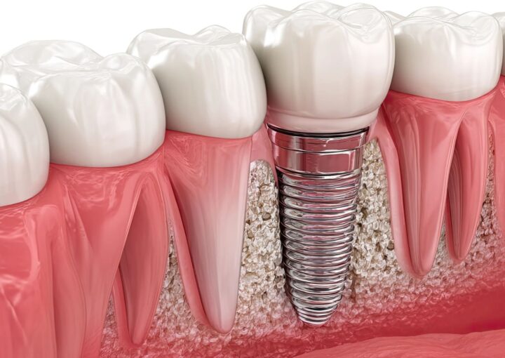 Eksik diş bölgesinde çene kemiği, dental implant ve implant üstü protezin anatomik yerleşimini gösteren diş hekimliği görseli.