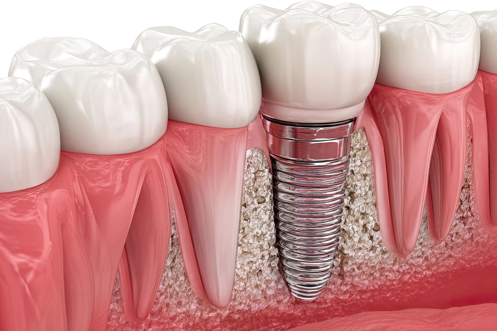 Eksik diş bölgesinde çene kemiği, dental implant ve implant üstü protezin anatomik yerleşimini gösteren diş hekimliği görseli.
