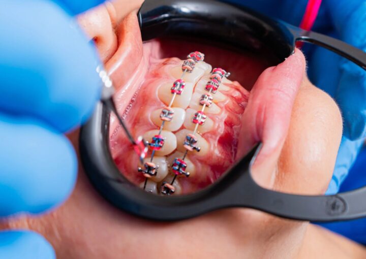 Eksik diş bölgesinde implant öncesi diş aralığı ve komşu diş köklerinin ortodontik olarak değerlendirildiği dental planlama.