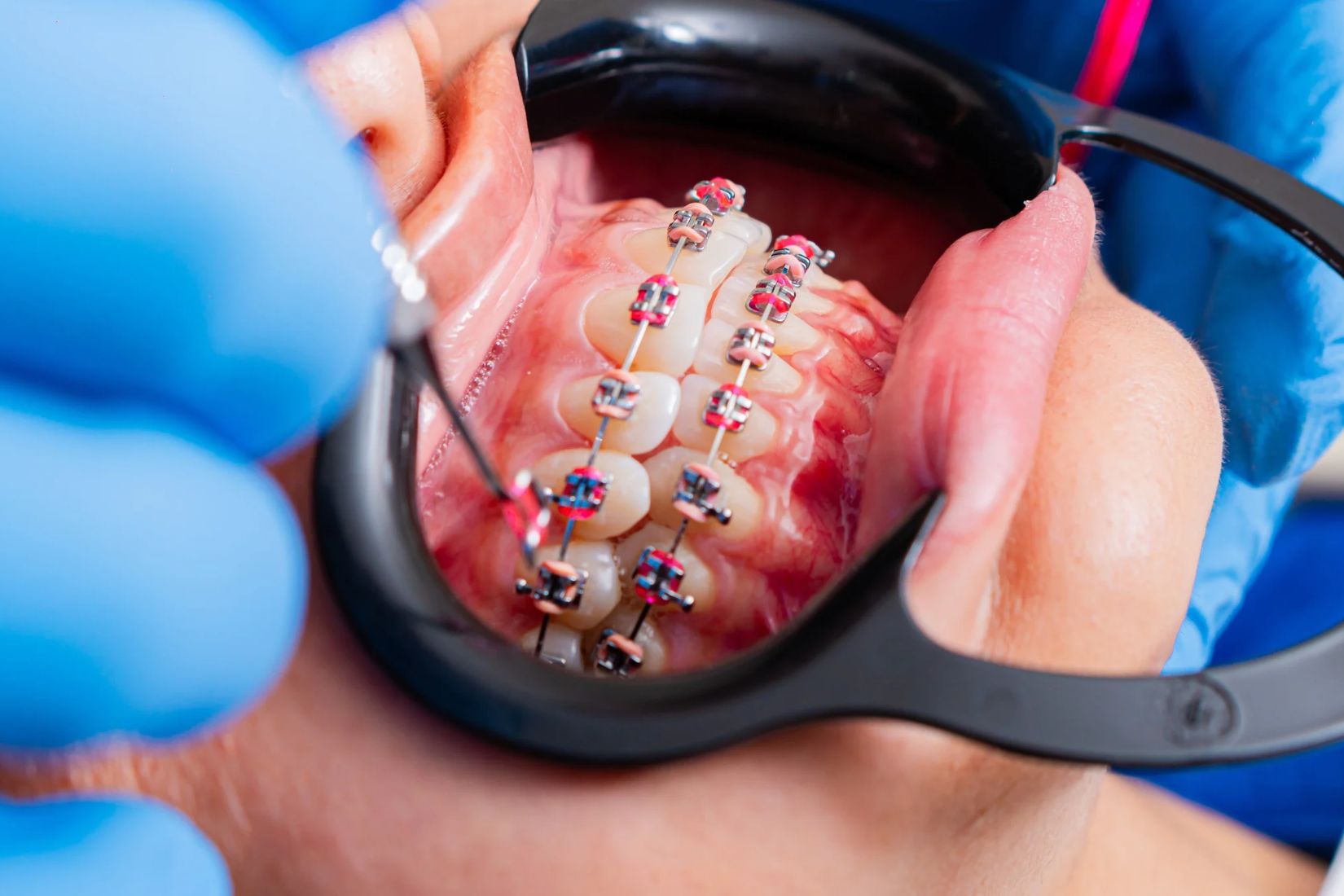 Eksik diş bölgesinde implant öncesi diş aralığı ve komşu diş köklerinin ortodontik olarak değerlendirildiği dental planlama.