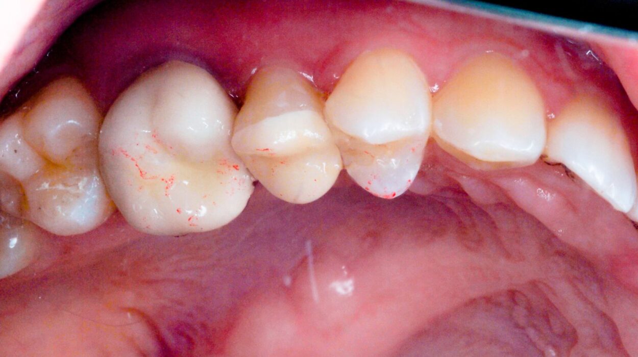 Arka dişte kalan sağlam dokular ve tüberküller değerlendirilerek planlanan adeziv overlay restorasyonun klinik görünümü.